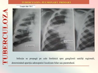 Infecţia se propagă pe cale limfatică spre ganglionii sateliţi regionali,
determinând apariţia adenopatiei localizate hilar sau paratraheal.
 