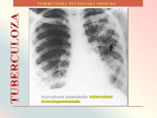 Post-primary tuberculosis: tuberculous
bronchopneumonia.
 