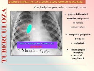 Complexul primar poate evolua cu complicaţii precum:
 compresia gangliono-
bronşică;
 atelectazii;
 fistulă ganglio-
bronşică;
 cavernă
ganglionară.
 procese inflamatorii
extensive benigne care
se numesc
epituberculoze;
 