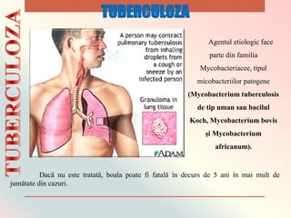 Dacă nu este tratată, boala poate fi fatală în decurs de 5 ani în mai mult de
jumătate din cazuri.
Agentul etiologic face
parte din familia
Mycobacteriacee, tipul
micobacteriilor patogene
(Mycobacterium tuberculosis
de tip uman sau bacilul
Koch, Mycobacterium bovis
şi Mycobacterium
africanum).
TUBERCULOZA
 