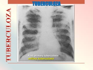 Post-primary tuberculosis:
miliary tuberculosis
TUBERCULOZA
 