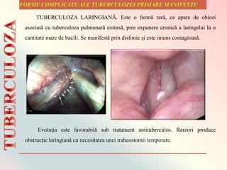 Evoluţia este favorabilă sub tratament antituberculos. Rareori produce
obstrucţie laringiană cu necesitatea unei traheostomii temporare.
TUBERCULOZA LARINGIANĂ. Este o formă rară, ce apare de obicei
asociată cu tuberculoza pulmonară extinsă, prin expunere cronică a laringelui la o
cantitate mare de bacili. Se manifestã prin disfonie şi este intens contagioasă.
 