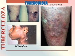 Eritem indurat
TBC ganglionar
TUBERCULOZA
 