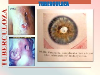 TUBERCULOZA
 