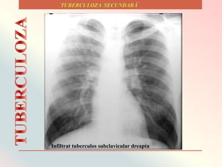 Infiltrat tuberculos subclavicular dreapta
 