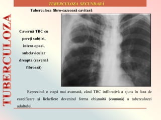 Cavernǎ TBC cu
pereți subțiri,
intens opaci,
subclavicular
dreapta (cavernǎ
fibroasǎ)
Reprezintǎ o etapǎ mai avansatǎ, cȃnd TBC infiltrativǎ a ajuns ȋn faza de
cazeificare și lichefiere devenind forma obișnuitǎ (comunǎ) a tuberculozei
adultului.
Tuberculoza fibro-cazeoasǎ cavitarǎ
 