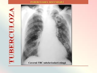 Cavernǎ TBC subclavicularǎ stȃngȃ
 