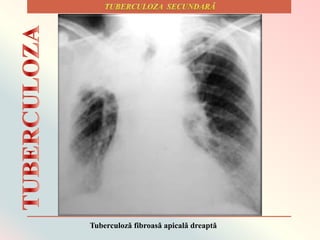 Tuberculozǎ fibroasǎ apicalǎ dreaptǎ
 
