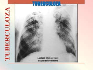 Leziuni fibrocavitare
diseminate bilateral
TUBERCULOZA
 