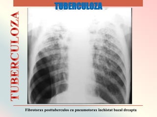 Fibrotorax posttuberculos cu pneumotorax ȋnchistat bazal dreapta
TUBERCULOZA
 