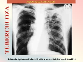 Tuberculoză pulmonară bilaterală infiltrativ-extensivă; BK pozitivă-recidivă
 