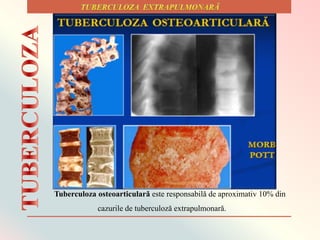 Tuberculoza osteoarticularǎ este responsabilǎ de aproximativ 10% din
cazurile de tuberculozǎ extrapulmonarǎ.
 
