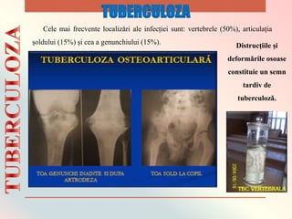 Cele mai frecvente localizǎri ale infecției sunt: vertebrele (50%), articulația
șoldului (15%) și cea a genunchiului (15%). Distrucțiile și
deformǎrile osoase
constituie un semn
tardiv de
tuberculozǎ.
TUBERCULOZA
 