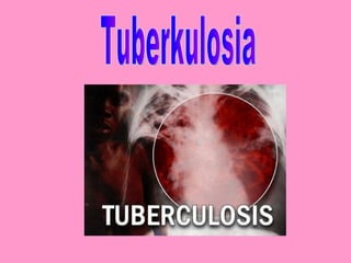Tuberkulosia 