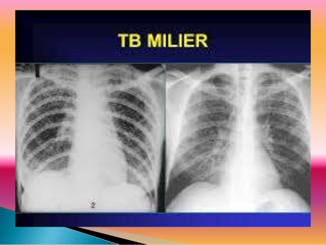 Tuberkulosis milier (milliary tb) dosen pkk ibu sri