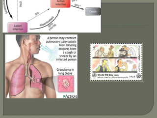 Tuberkulosis penyuluhan