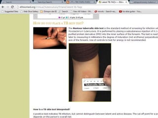 Tuberkulosis penyuluhan