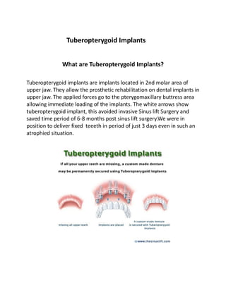 Tuberopterygoid Implants
What are Tuberopterygoid Implants?
Tuberopterygoid implants are implants located in 2nd molar area of
upper jaw. They allow the prosthetic rehabilitation on dental implants in
upper jaw. The applied forces go to the pterygomaxillary buttress area
allowing immediate loading of the implants. The white arrows show
tuberopterygoid implant, this avoided invasive Sinus lift Surgery and
saved time period of 6-8 months post sinus lift surgery.We were in
position to deliver fixed teeeth in period of just 3 days even in such an
atrophied situation.
 