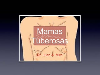 Mamas
Tuberosas
Dr. Juan A. Mira
 