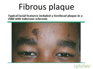 Fibrous plaque
 