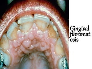 Gingival
fibromat
osis
 