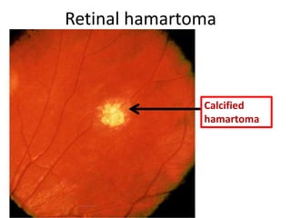 Retinal hamartoma
Calcified
hamartoma
 