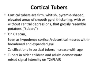 Cortical Tubers
• Cortical tubers are firm, whitish, pyramid-shaped,
elevated areas of smooth gyral thickening, with or
without central depressions, that grossly resemble
potatoes ("tubers")
• On CT scan,
Seen as hypodense cortical/subcortical masses within
broadened and expanded gyri
Calcifications in cortical tubers increase with age
• Tubers in older children and adults demonstrate
mixed signal intensity on T2/FLAIR
 