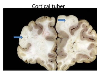 Cortical tuber
 