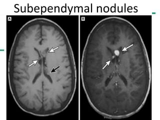 Subependymal nodules
 