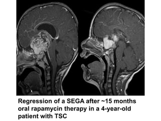 Regression of a SEGA after ~15 months
oral rapamycin therapy in a 4-year-old
patient with TSC
 