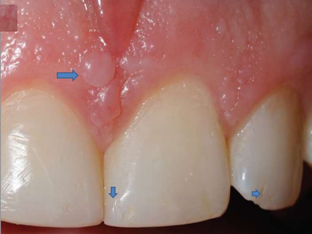Tuberous Sclerosis Tuberous Sclerosis