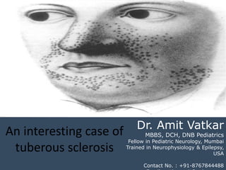 Dr. Amit Vatkar
MBBS, DCH, DNB Pediatrics
Fellow in Pediatric Neurology, Mumbai
Trained in Neurophysiology & Epilepsy,
USA
Contact No. : +91-8767844488
An interesting case of
tuberous sclerosis
 