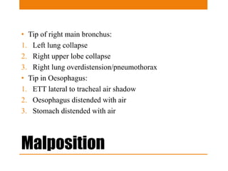 Malposition
• Tip of right main bronchus:
1. Left lung collapse
2. Right upper lobe collapse
3. Right lung overdistension/pneumothorax
• Tip in Oesophagus:
1. ETT lateral to tracheal air shadow
2. Oesophagus distended with air
3. Stomach distended with air
 
