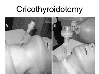 Cricothyroidotomy 