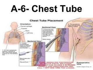 A-6- Chest Tube 