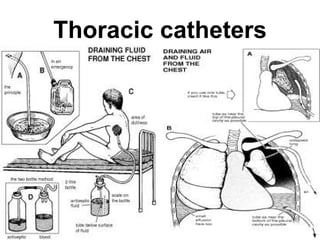 Thoracic catheters 
