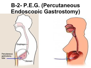 B-2- P.E.G. (Percutaneous Endoscopic Gastrostomy) 