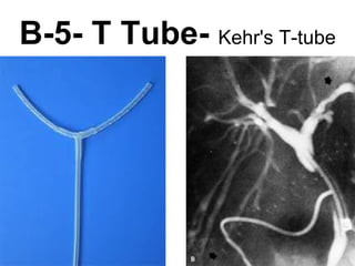 B-5- T Tube-  Kehr's T-tube 