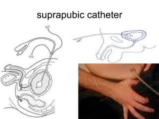suprapubic catheter 