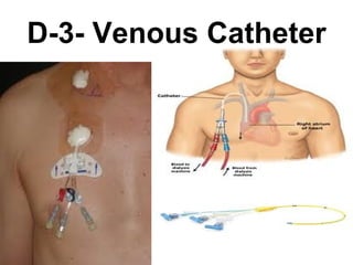 D-3- Venous Catheter 