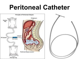 Peritoneal Catheter 