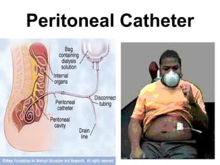 Peritoneal Catheter 