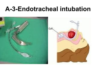 A-3-Endotracheal intubation 