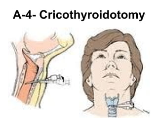 A-4- Cricothyroidotomy 
