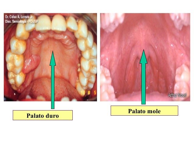 Palato Duro