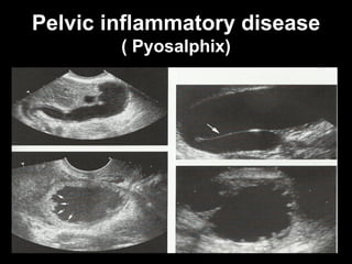 Tuboovarian pathologies us hrpb edited 2019 | PDF