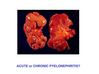 ACUTE or CHRONIC PYELONEPHRITIS?
 