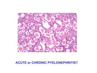 ACUTE or CHRONIC PYELONEPHRITIS?
 