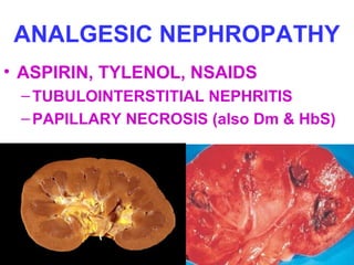 ANALGESIC NEPHROPATHY
• ASPIRIN, TYLENOL, NSAIDS
–TUBULOINTERSTITIAL NEPHRITIS
–PAPILLARY NECROSIS (also Dm & HbS)
 