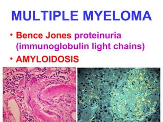 MULTIPLE MYELOMA
• Bence Jones proteinuria
(immunoglobulin light chains)
• AMYLOIDOSIS
 